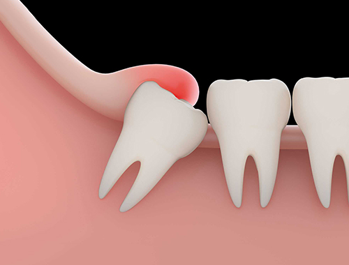 PAINLESS WISDOM TEETH