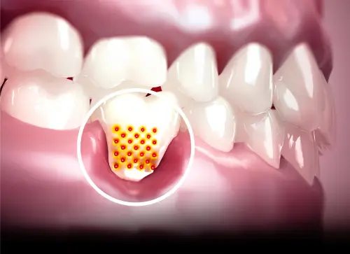 TEETH SENSITIVITY TREATMENT