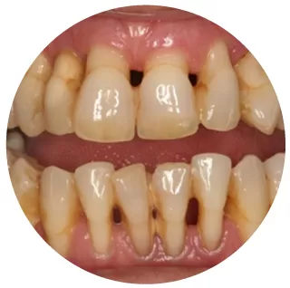răng bị mòn vẹt