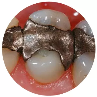 răng bị mẻ có miếng trám